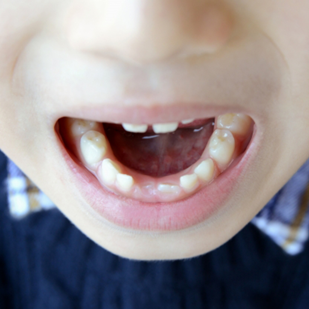 練習中や試合中に歯が抜けたら？