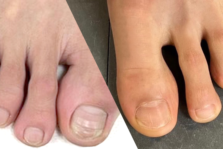 足の爪を正しく切っていますか？