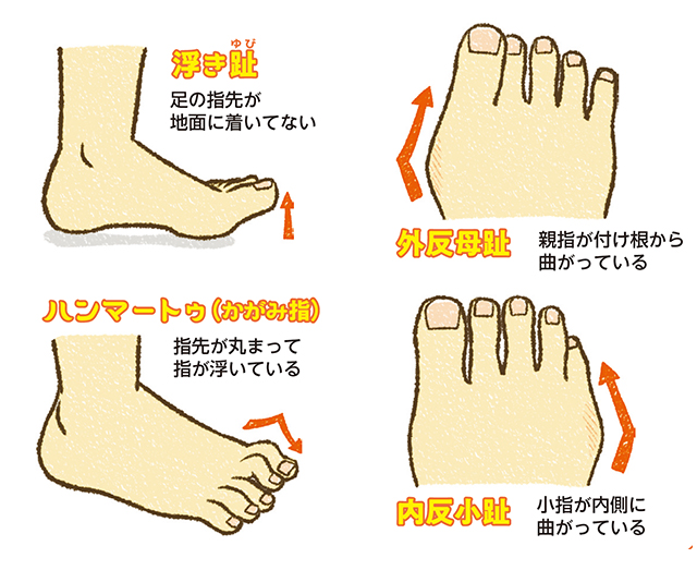 子どもの足、大丈夫? 起こりやすい足のトラブル