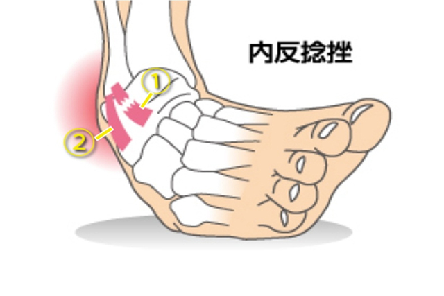捻挫(靭帯損傷)の程度